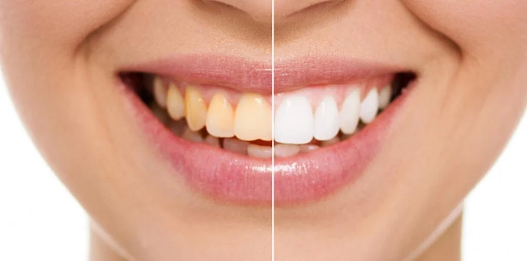 Bleaching — professionelle Zahnaufhellung, Zahnarztpraxis Dr. Hauschildt Berlin-Reinickendorf